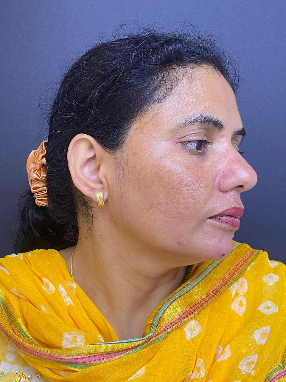 After treatment